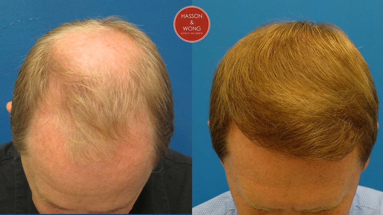 The future of hair loss treatments: What's on the horizon?