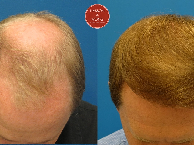 The future of hair loss treatments: What's on the horizon?